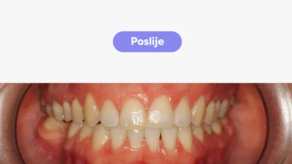 Orto Tea S Fullface Poslije V2
